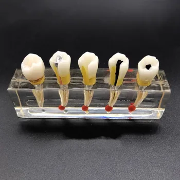 Модель обучения стоматологии Модель лечения корневых каналов Модель восстановления пульпы Модель практики имплантации