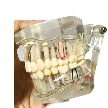 Стоматологическое исследование Модель прозрачных зубов взрослых патологоанатомических и болезненных зубов